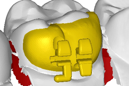 bracket